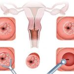 Chẩn đoán và điều trị viêm cổ tử cung