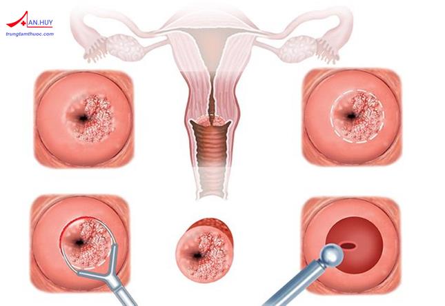 Chẩn đoán và điều trị viêm cổ tử cung