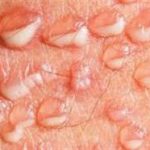 Mụn rộp sinh dục: chẩn đoán và điều trị