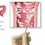 Triệu chứng, nguyên nhân và cách phòng ngừa viêm âm đạo